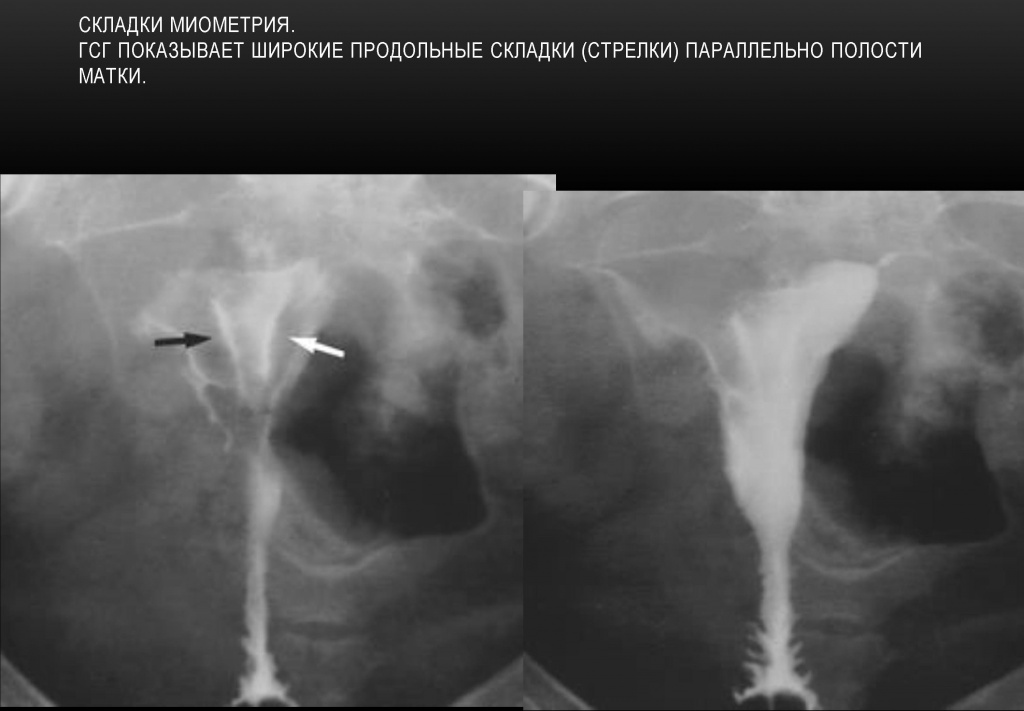 Складки миометрия Складки миометрия