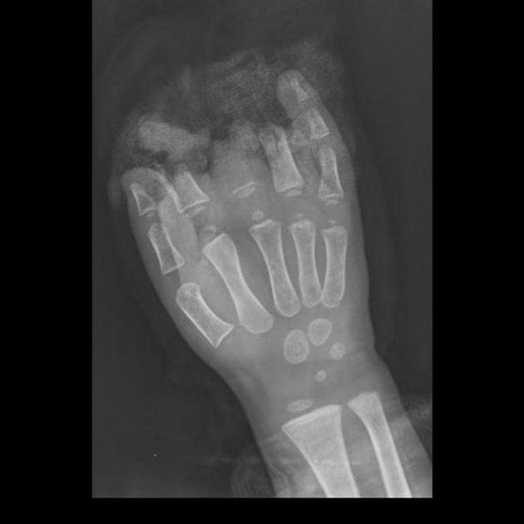 traumatic-phalax-amputation1.JPEG traumatic-phalax-amputation1.JPEG