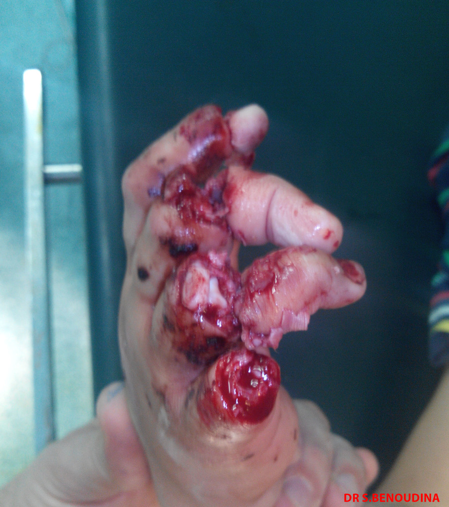 firecracker-accident-traumatic-phalanges-amputation3.jpg firecracker-accident-traumatic-phalanges-amputation3.jpg
