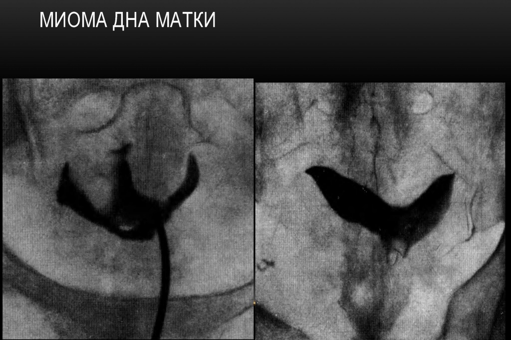 Миома дна матки Миома дна матки