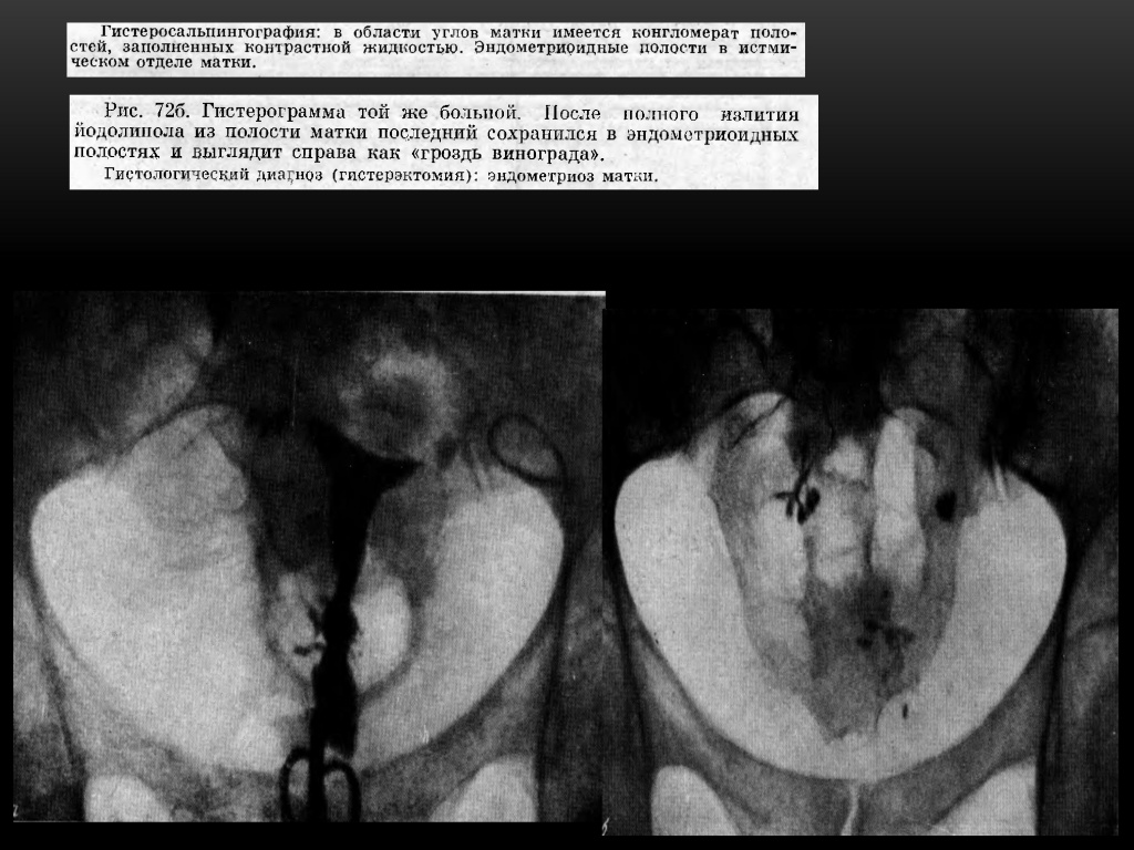 Эндометриоз матки Эндометриоз матки