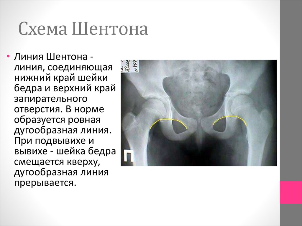 Линия Шелтона Линия Шелтона