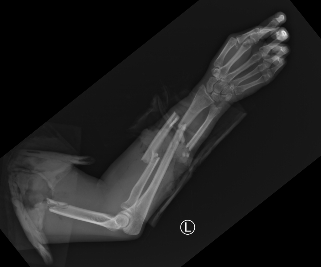 traumatic-arm-amputation.jpg traumatic-arm-amputation.jpg