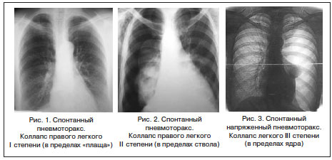 Спонтанный пневмоторакс Спонтанный пневмоторакс
