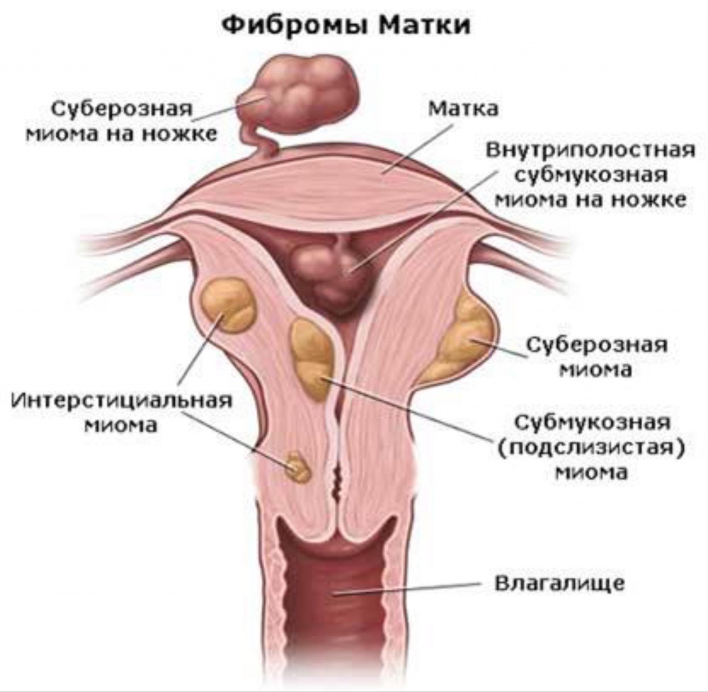 Фибромы матки Фибромы матки