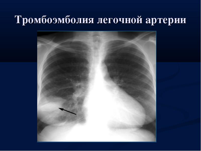рентген легких ТЭЛА рентген легких