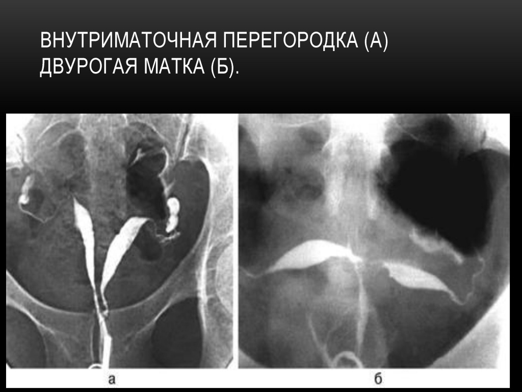 Внутриматочная перегородка и двурогая матка Внутриматочная перегородка и двурогая матка
