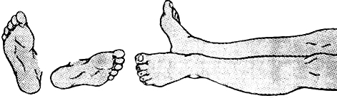 Положение ног при переломе шейки бедра