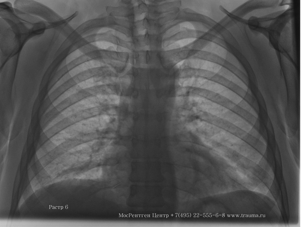 Рентгенограмма грудной клетки. Рентгенаппарат Арман 10Л6-011 и рентгеновский оцифровщик Vita CR Carestream.
