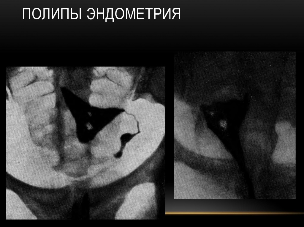Полип эндометрия Полип эндометрия