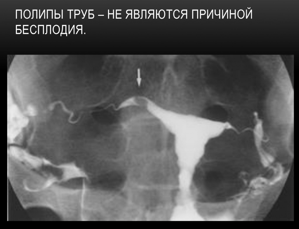 Полип маточной трубы Полип маточной трубы