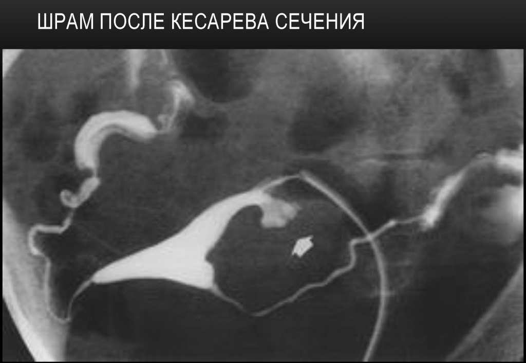 Шрам после кесарева сечения Шрам после кесарева сечения