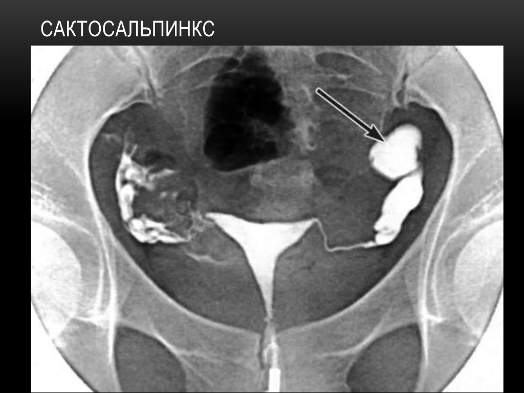 Сактосальпинкс Сактосальпинкс