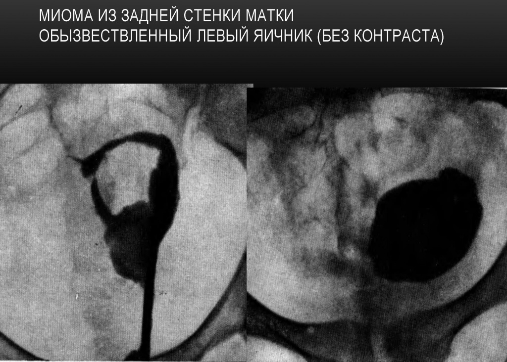 Миома из задней стенки матки Миома из задней стенки матки