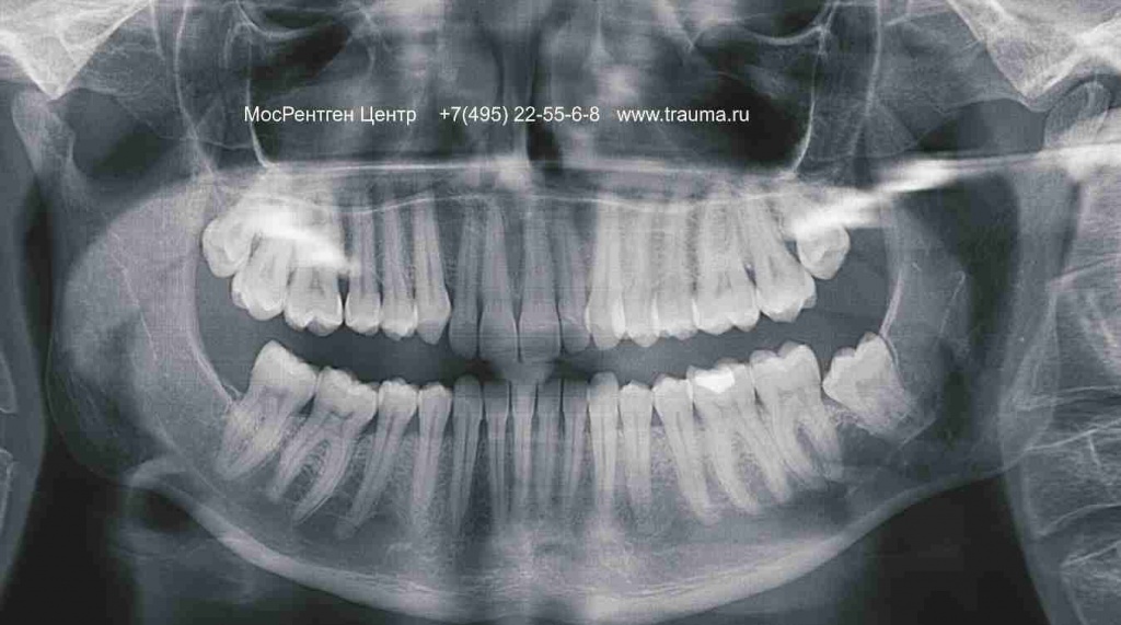 Orthopantomogramma_dve_pary_linij_na_1_mm.jpg Orthopantomogramma_dve_pary_linij_na_1_mm.jpg