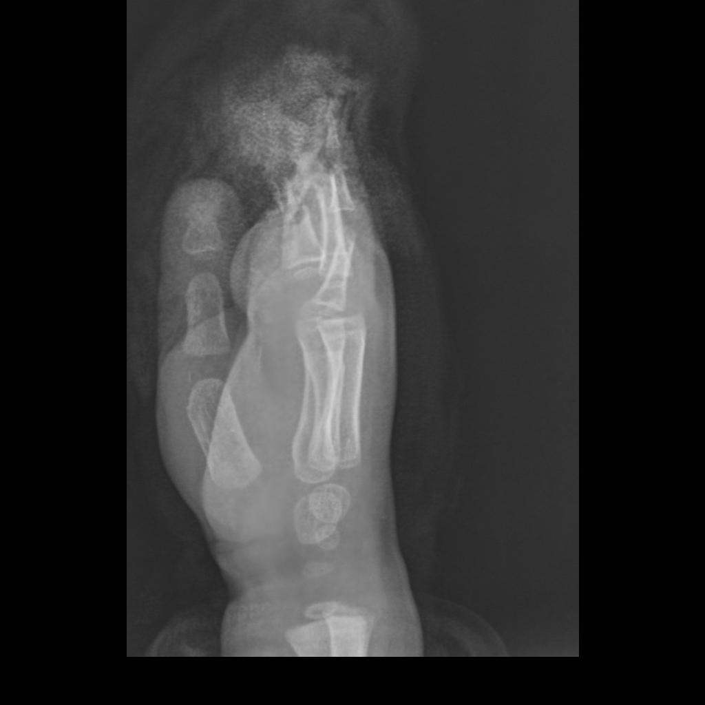 traumatic-phalax-amputation2.JPEG traumatic-phalax-amputation2.JPEG