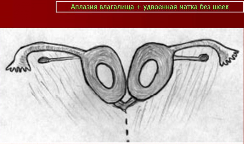 Синдром Майера-Рокитанского-Кюстера - наследственные аномалии развития матки (возможно, аутосомно-доминантное наследование).В анамнезе первичная аменорея, стерильность; нормальное развитие вторичных половых признаков и нормальное появление менструаций. Иногда викарирующие кровотечения из мочевого пузыря, прямой кишки, полости рта или носа. Наружные гениталии: общая гипоплазия, часто дорсальное расположение и воронкообразное расширение отверстий мочеиспускательного канала. Внутренние гениталии — влагалище почти полностью отсутствует; матка обычно разделена на 2 части, без полости, эндометрий отсутствует; яичники расположены относительно высоко, яйцевод гипопластический, но с просветом. Вторичные половые признаки: нормальный женский внешний облик, развитие молочных желез нормальное, оволосение типично для женского пола. Нормальное половое влечение. Овариальная функция: нормальная базальная температура, нормальное содержание прегнандиола и эстрогенов в моче. Нередко сочетается с аномалиями почек и мочевых путей; иногда наблюдаются врожденная аневризма аорты, аномалии мезентерия, сакрализация 5 поясничного позвонка, гипоплазия XII ребра. Синдром Майера-Рокитанского-Кюстера - наследственные аномалии развития матки (возможно, аутосомно-доминантное наследование).В анамнезе первичная аменорея, стерильность; нормальное развитие вторичных половых признаков и нормальное появление менструаций. Иногда викарирующие кровотечения из мочевого пузыря, прямой кишки, полости рта или носа. Наружные гениталии: общая гипоплазия, часто дорсальное расположение и воронкообразное расширение отверстий мочеиспускательного канала. Внутренние гениталии — влагалище почти полностью отсутствует; матка обычно разделена на 2 части, без полости, эндометрий отсутствует; яичники расположены относительно высоко, яйцевод гипопластический, но с просветом. Вторичные половые признаки: нормальный женский внешний облик, развитие молочных желез нормальное, оволосение типично для женского пола. Нормальное половое влечение. Овариальная функция: нормальная базальная температура, нормальное содержание прегнандиола и эстрогенов в моче. Нередко сочетается с аномалиями почек и мочевых путей; иногда наблюдаются врожденная аневризма аорты, аномалии мезентерия, сакрализация 5 поясничного позвонка, гипоплазия XII ребра.