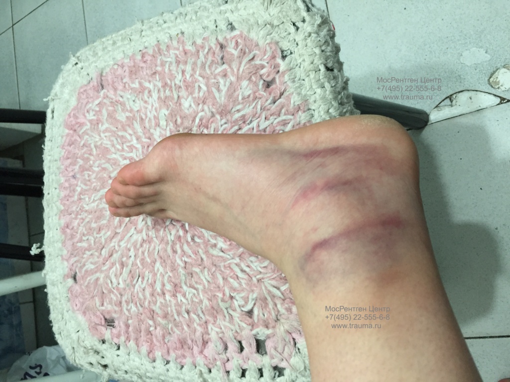 Повреждение голеностопного сустава Повреждение голеностопного сустава