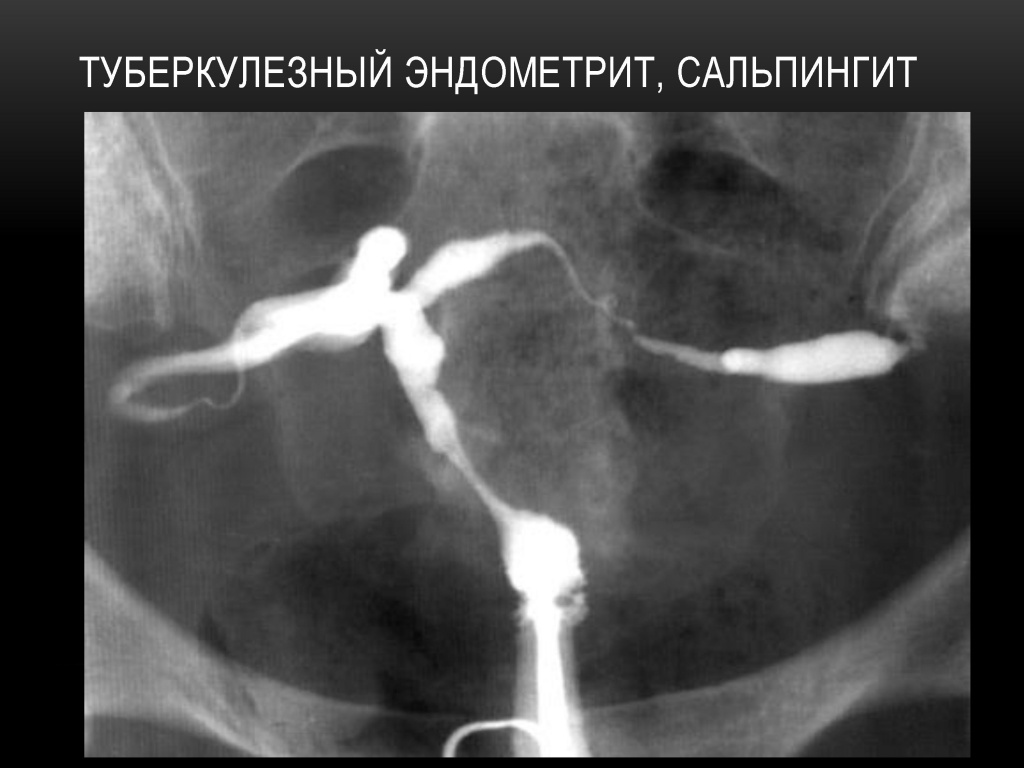 Туберкулезный эндометрит и сальпингит Туберкулезный эндометрит и сальпингит