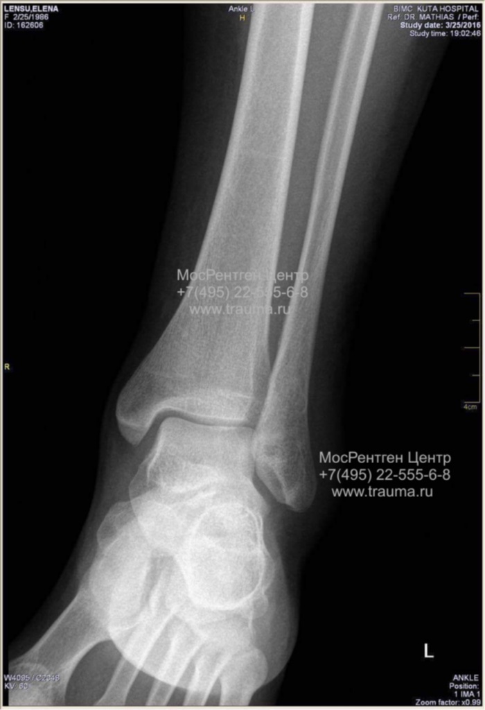 перелом наружной лодыжки DR перелом наружной лодыжки DR