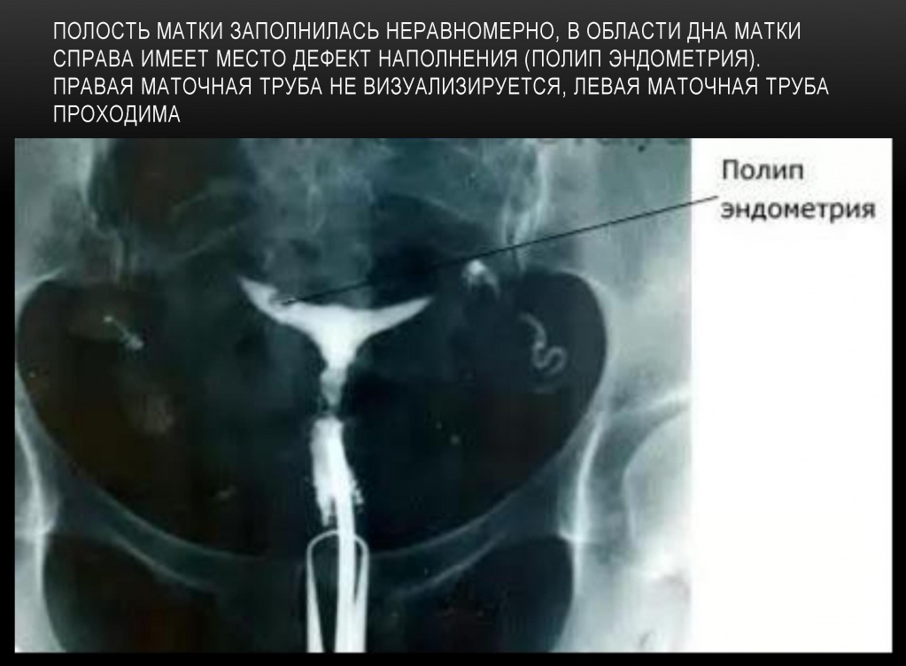 Полип эндометрия Полип эндометрия