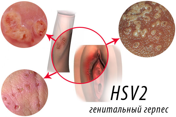 Генитальный герпес Генитальный герпес