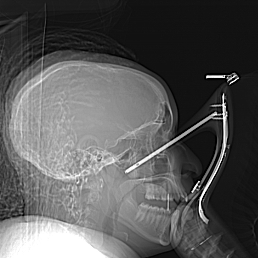 orbital-foreign-body-stiletto-shoe.jpg orbital-foreign-body-stiletto-shoe.jpg
