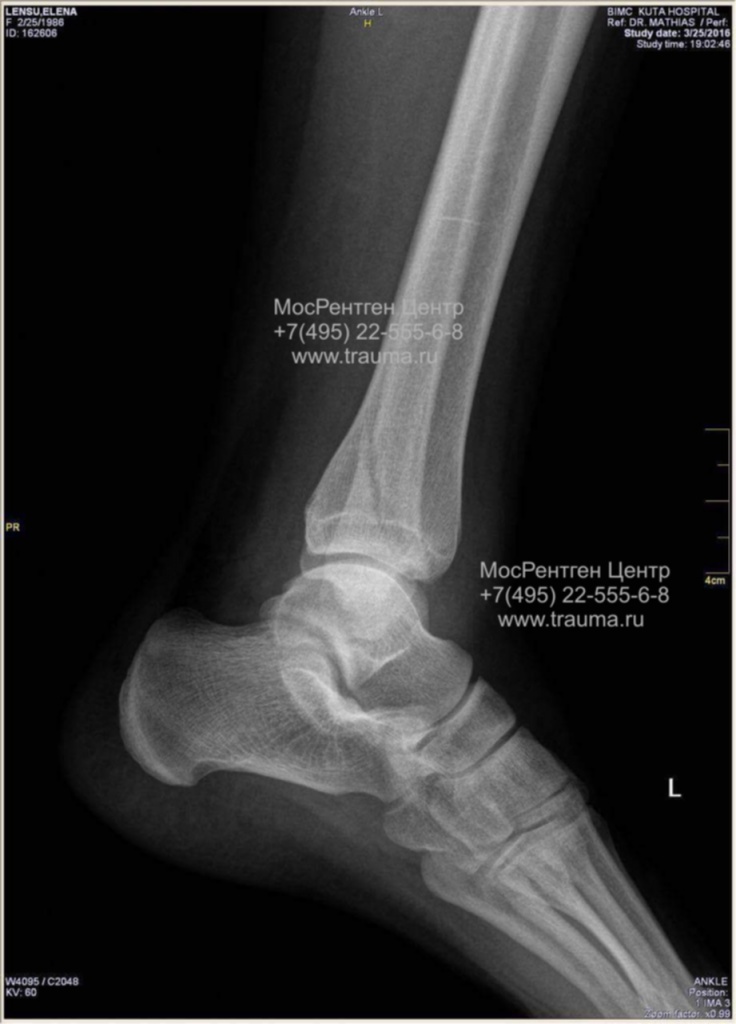 перелом наружной лодыжки DR перелом наружной лодыжки DR