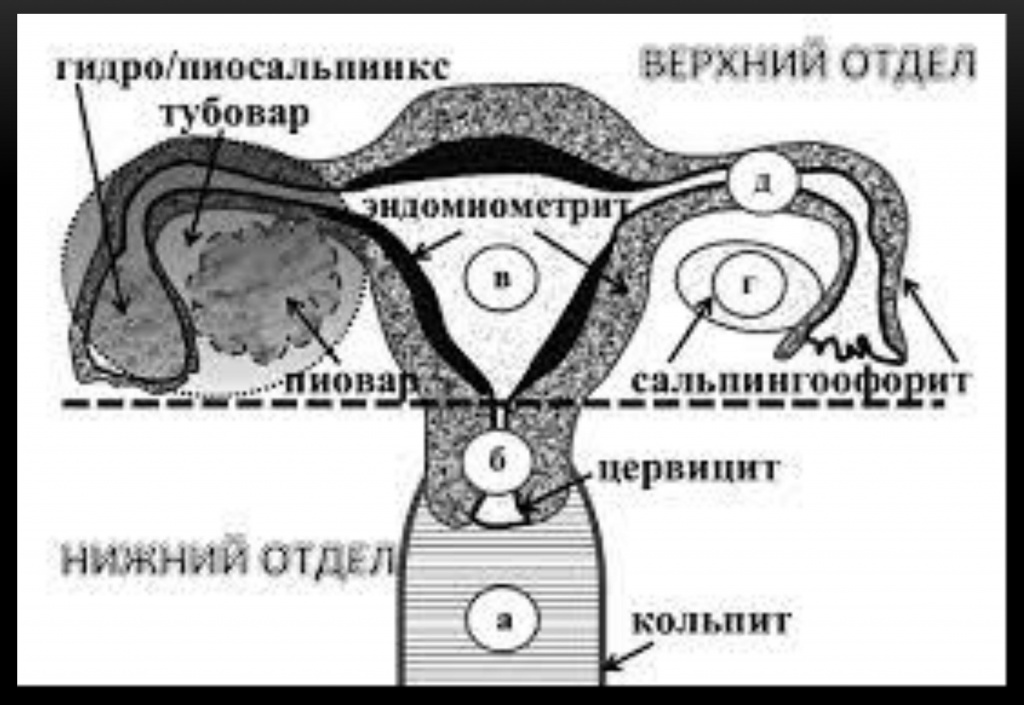 Анатомия женской половой системы с указанием возможных заболеваний Анатомия женской половой системы с указанием возможных заболеваний