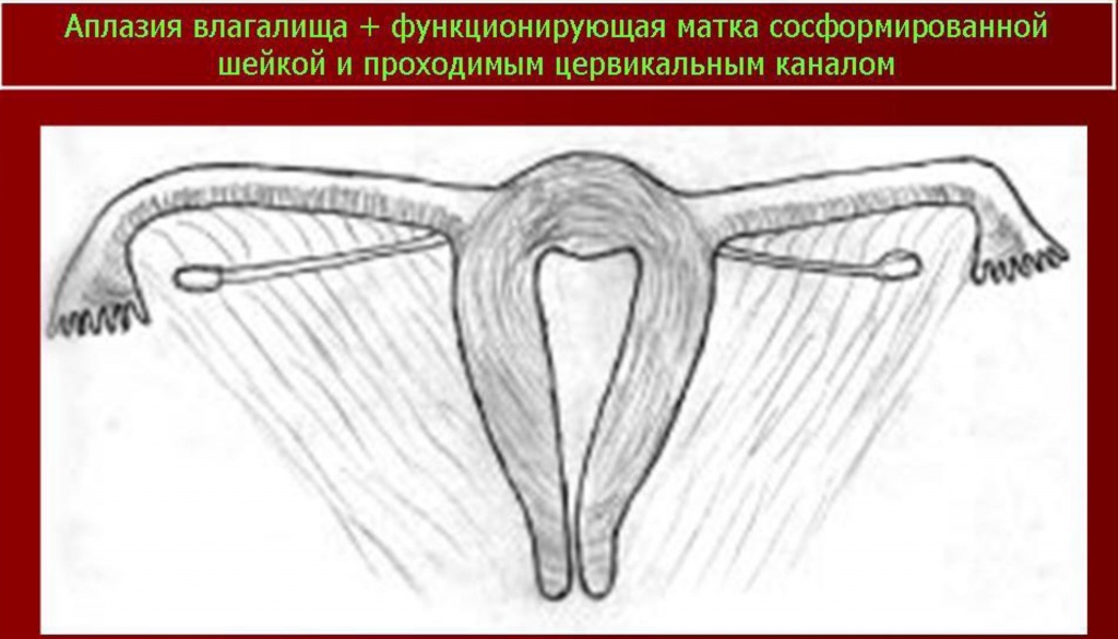 Синдром Майера-Рокитанского-Кюстера - наследственные аномалии развития матки (возможно, аутосомно-доминантное наследование).В анамнезе первичная аменорея, стерильность; нормальное развитие вторичных половых признаков и нормальное появление менструаций. Иногда викарирующие кровотечения из мочевого пузыря, прямой кишки, полости рта или носа. Наружные гениталии: общая гипоплазия, часто дорсальное расположение и воронкообразное расширение отверстий мочеиспускательного канала. Внутренние гениталии — влагалище почти полностью отсутствует; матка обычно разделена на 2 части, без полости, эндометрий отсутствует; яичники расположены относительно высоко, яйцевод гипопластический, но с просветом. Вторичные половые признаки: нормальный женский внешний облик, развитие молочных желез нормальное, оволосение типично для женского пола. Нормальное половое влечение. Овариальная функция: нормальная базальная температура, нормальное содержание прегнандиола и эстрогенов в моче. Нередко сочетается с аномалиями почек и мочевых путей; иногда наблюдаются врожденная аневризма аорты, аномалии мезентерия, сакрализация 5 поясничного позвонка, гипоплазия XII ребра. Синдром Майера-Рокитанского-Кюстера - наследственные аномалии развития матки (возможно, аутосомно-доминантное наследование).В анамнезе первичная аменорея, стерильность; нормальное развитие вторичных половых признаков и нормальное появление менструаций. Иногда викарирующие кровотечения из мочевого пузыря, прямой кишки, полости рта или носа. Наружные гениталии: общая гипоплазия, часто дорсальное расположение и воронкообразное расширение отверстий мочеиспускательного канала. Внутренние гениталии — влагалище почти полностью отсутствует; матка обычно разделена на 2 части, без полости, эндометрий отсутствует; яичники расположены относительно высоко, яйцевод гипопластический, но с просветом. Вторичные половые признаки: нормальный женский внешний облик, развитие молочных желез нормальное, оволосение типично для женского пола. Нормальное половое влечение. Овариальная функция: нормальная базальная температура, нормальное содержание прегнандиола и эстрогенов в моче. Нередко сочетается с аномалиями почек и мочевых путей; иногда наблюдаются врожденная аневризма аорты, аномалии мезентерия, сакрализация 5 поясничного позвонка, гипоплазия XII ребра.