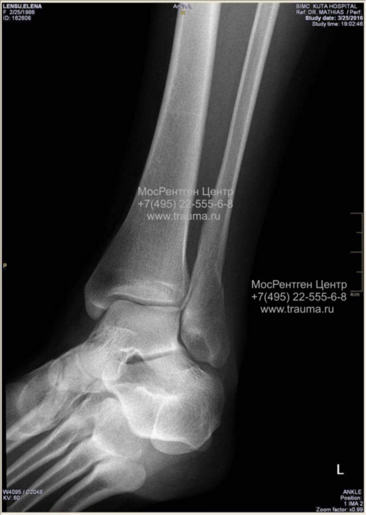 перелом наружной лодыжки DR перелом наружной лодыжки DR