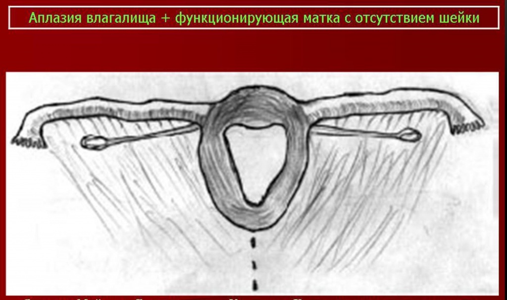 Синдром Майера-Рокитанского-Кюстера - наследственные аномалии развития матки (возможно, аутосомно-доминантное наследование).В анамнезе первичная аменорея, стерильность; нормальное развитие вторичных половых признаков и нормальное появление менструаций. Иногда викарирующие кровотечения из мочевого пузыря, прямой кишки, полости рта или носа. Наружные гениталии: общая гипоплазия, часто дорсальное расположение и воронкообразное расширение отверстий мочеиспускательного канала. Внутренние гениталии — влагалище почти полностью отсутствует; матка обычно разделена на 2 части, без полости, эндометрий отсутствует; яичники расположены относительно высоко, яйцевод гипопластический, но с просветом. Вторичные половые признаки: нормальный женский внешний облик, развитие молочных желез нормальное, оволосение типично для женского пола. Нормальное половое влечение. Овариальная функция: нормальная базальная температура, нормальное содержание прегнандиола и эстрогенов в моче. Нередко сочетается с аномалиями почек и мочевых путей; иногда наблюдаются врожденная аневризма аорты, аномалии мезентерия, сакрализация 5 поясничного позвонка, гипоплазия XII ребра. Синдром Майера-Рокитанского-Кюстера - наследственные аномалии развития матки (возможно, аутосомно-доминантное наследование).В анамнезе первичная аменорея, стерильность; нормальное развитие вторичных половых признаков и нормальное появление менструаций. Иногда викарирующие кровотечения из мочевого пузыря, прямой кишки, полости рта или носа. Наружные гениталии: общая гипоплазия, часто дорсальное расположение и воронкообразное расширение отверстий мочеиспускательного канала. Внутренние гениталии — влагалище почти полностью отсутствует; матка обычно разделена на 2 части, без полости, эндометрий отсутствует; яичники расположены относительно высоко, яйцевод гипопластический, но с просветом. Вторичные половые признаки: нормальный женский внешний облик, развитие молочных желез нормальное, оволосение типично для женского пола. Нормальное половое влечение. Овариальная функция: нормальная базальная температура, нормальное содержание прегнандиола и эстрогенов в моче. Нередко сочетается с аномалиями почек и мочевых путей; иногда наблюдаются врожденная аневризма аорты, аномалии мезентерия, сакрализация 5 поясничного позвонка, гипоплазия XII ребра.
