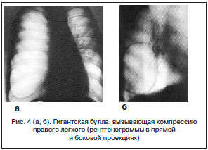 Спонтанный пневмоторакс Спонтанный пневмоторакс