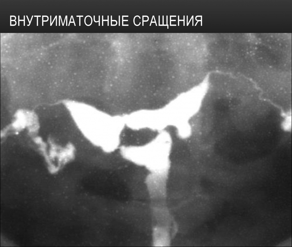 Внутриматочные сращения Внутриматочные сращения