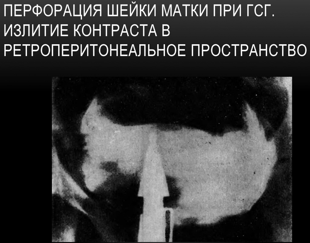 Перфорация шейки матки при гистеросальпингографии Перфорация шейки матки при гистеросальпингографии