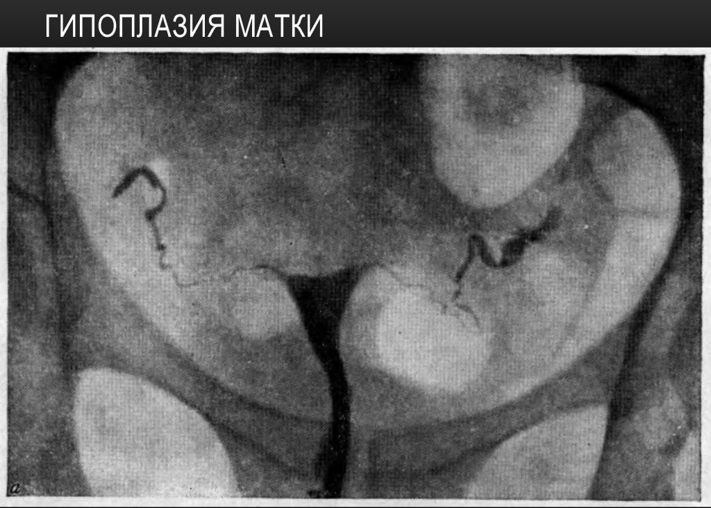 Гипоплазия матки Гипоплазия матки