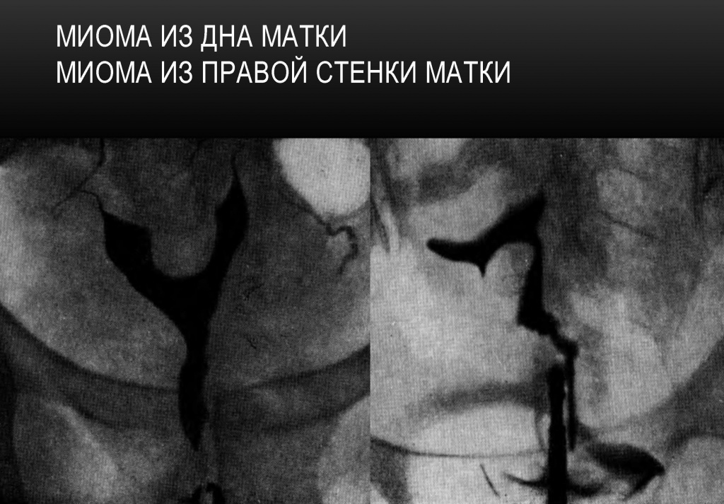 Миома дна матки. Миома право стенки матки. Миома дна матки. Миома право стенки матки.