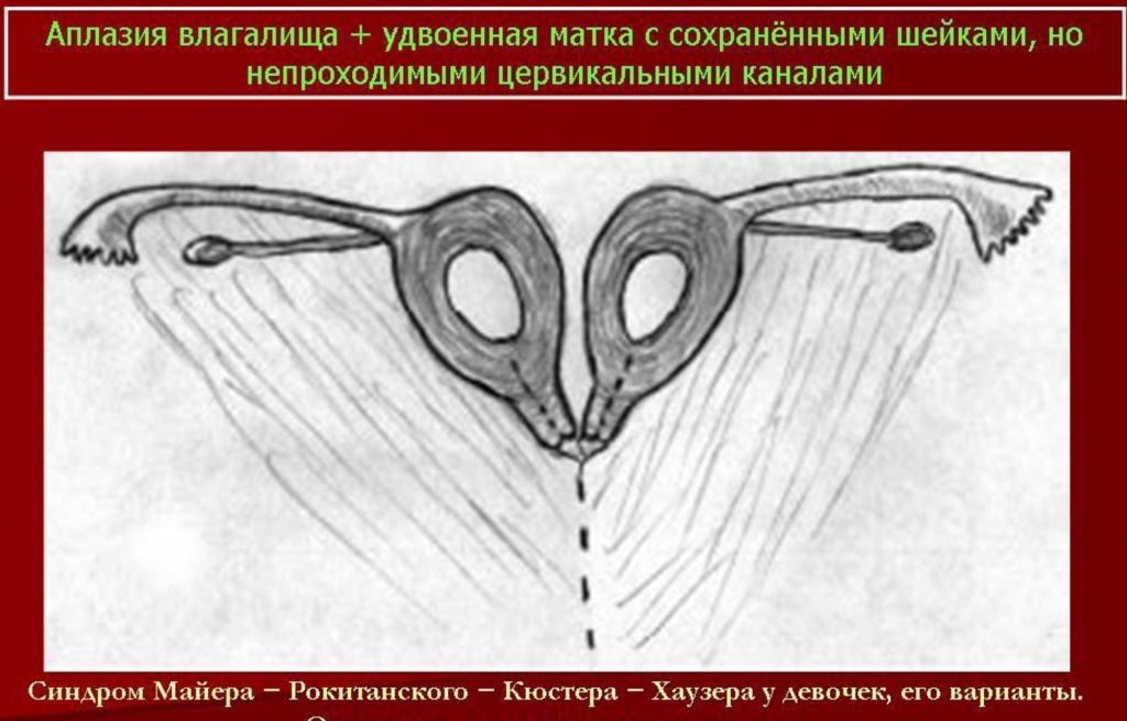 Синдром Майера-Рокитанского-Кюстера - наследственные аномалии развития матки (возможно, аутосомно-доминантное наследование).В анамнезе первичная аменорея, стерильность; нормальное развитие вторичных половых признаков и нормальное появление менструаций. Иногда викарирующие кровотечения из мочевого пузыря, прямой кишки, полости рта или носа. Наружные гениталии: общая гипоплазия, часто дорсальное расположение и воронкообразное расширение отверстий мочеиспускательного канала. Внутренние гениталии — влагалище почти полностью отсутствует; матка обычно разделена на 2 части, без полости, эндометрий отсутствует; яичники расположены относительно высоко, яйцевод гипопластический, но с просветом. Вторичные половые признаки: нормальный женский внешний облик, развитие молочных желез нормальное, оволосение типично для женского пола. Нормальное половое влечение. Овариальная функция: нормальная базальная температура, нормальное содержание прегнандиола и эстрогенов в моче. Нередко сочетается с аномалиями почек и мочевых путей; иногда наблюдаются врожденная аневризма аорты, аномалии мезентерия, сакрализация 5 поясничного позвонка, гипоплазия XII ребра. Синдром Майера-Рокитанского-Кюстера - наследственные аномалии развития матки (возможно, аутосомно-доминантное наследование).В анамнезе первичная аменорея, стерильность; нормальное развитие вторичных половых признаков и нормальное появление менструаций. Иногда викарирующие кровотечения из мочевого пузыря, прямой кишки, полости рта или носа. Наружные гениталии: общая гипоплазия, часто дорсальное расположение и воронкообразное расширение отверстий мочеиспускательного канала. Внутренние гениталии — влагалище почти полностью отсутствует; матка обычно разделена на 2 части, без полости, эндометрий отсутствует; яичники расположены относительно высоко, яйцевод гипопластический, но с просветом. Вторичные половые признаки: нормальный женский внешний облик, развитие молочных желез нормальное, оволосение типично для женского пола. Нормальное половое влечение. Овариальная функция: нормальная базальная температура, нормальное содержание прегнандиола и эстрогенов в моче. Нередко сочетается с аномалиями почек и мочевых путей; иногда наблюдаются врожденная аневризма аорты, аномалии мезентерия, сакрализация 5 поясничного позвонка, гипоплазия XII ребра.