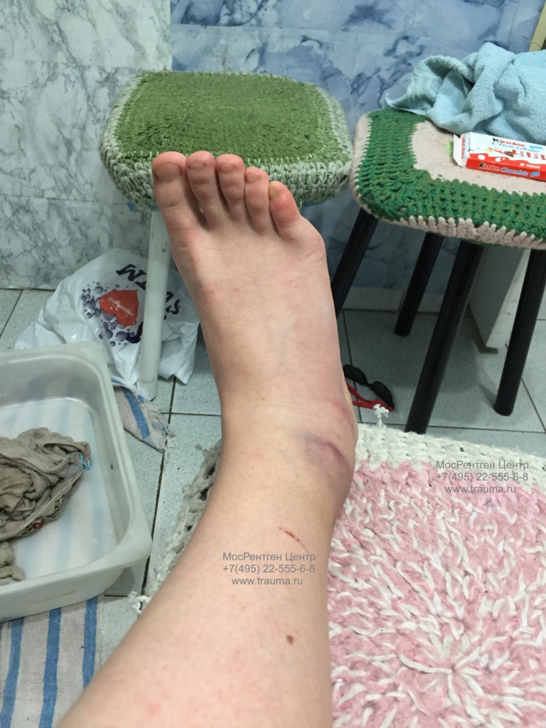 Повреждение голеностопного сустава Повреждение голеностопного сустава