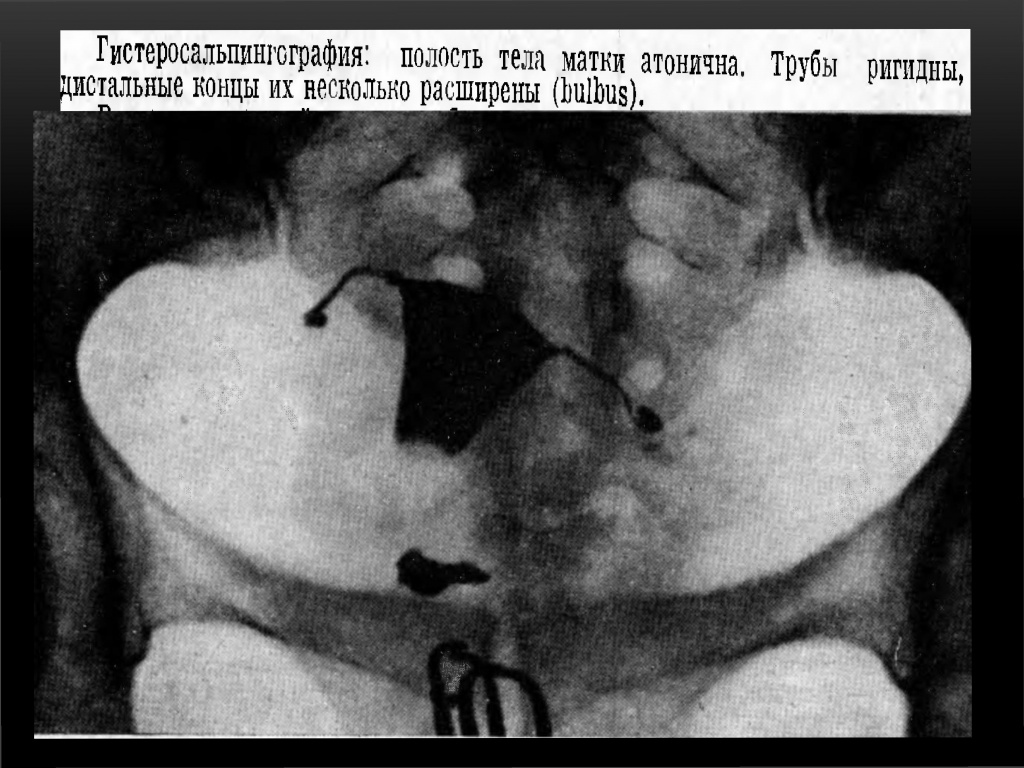 Туберкулезный эндометрит Туберкулезный эндометрит