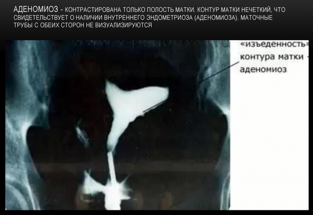 Аденомиоз Аденомиоз