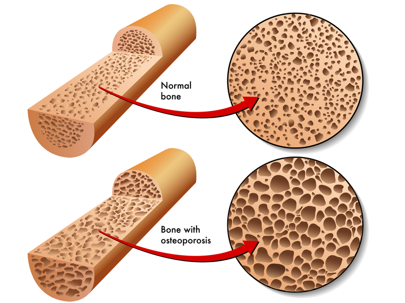 osteoporosis.jpg