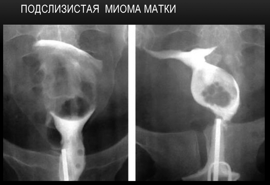 Подслизистая миома матки Подслизистая миома матки