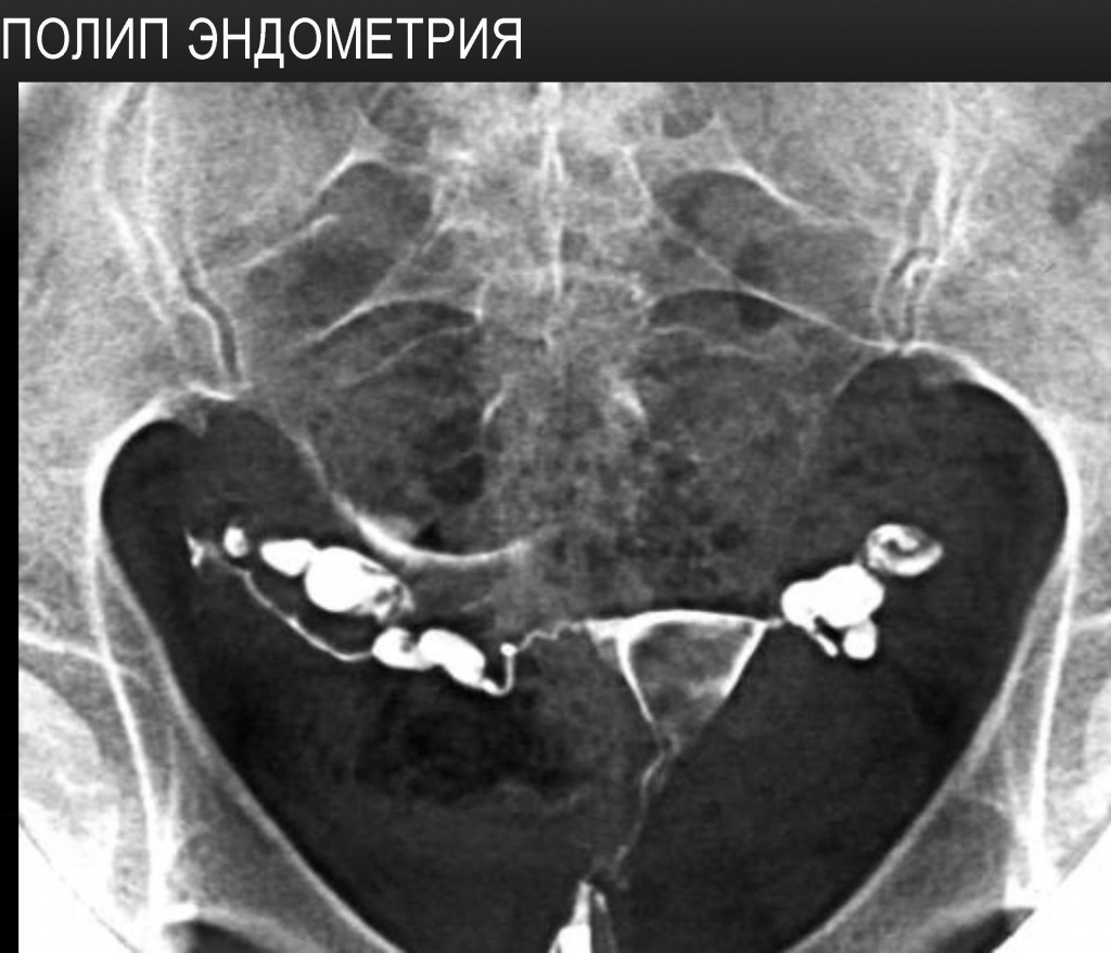 Полип эндометрия Полип эндометрия
