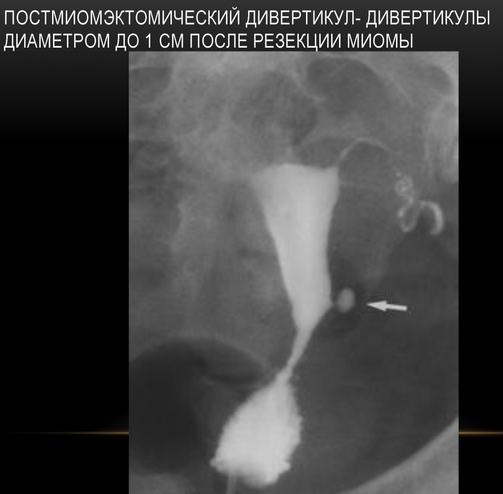 Дивертикул после удаления миомы Дивертикул после удаления миомы