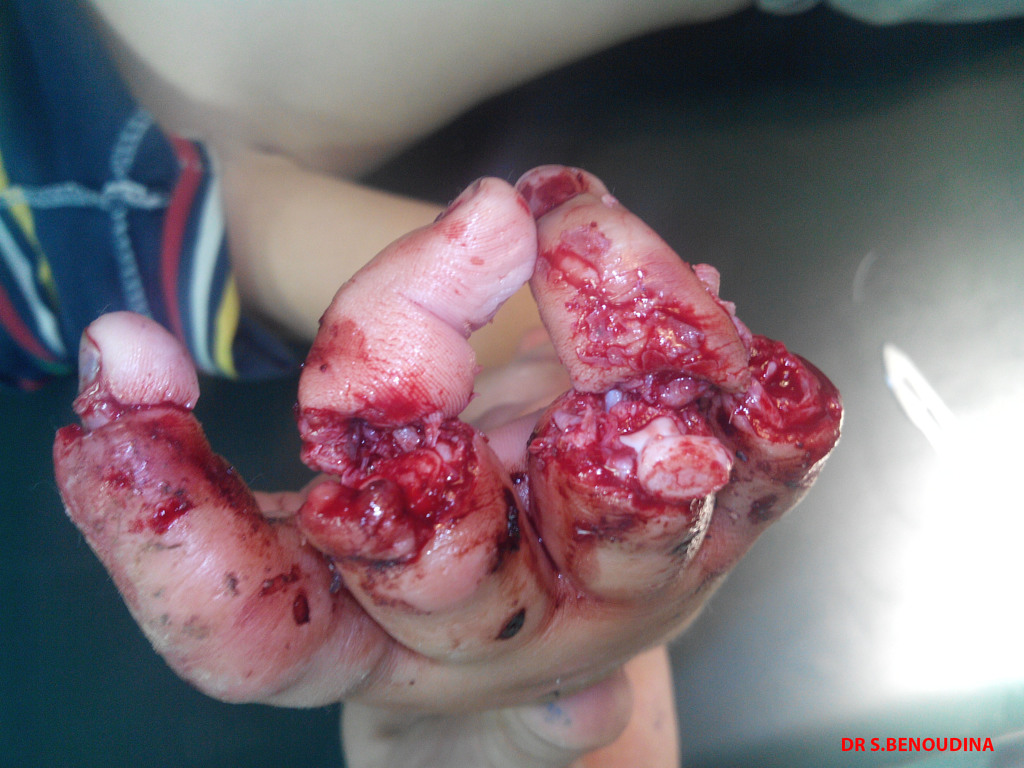 firecracker-accident-traumatic-phalanges-amputation2.jpg firecracker-accident-traumatic-phalanges-amputation2.jpg