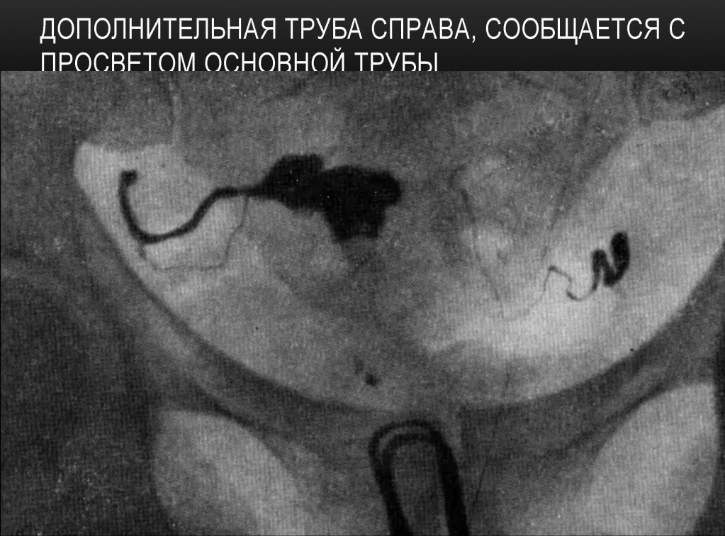 Дополнительная труба справа Дополнительная труба справа