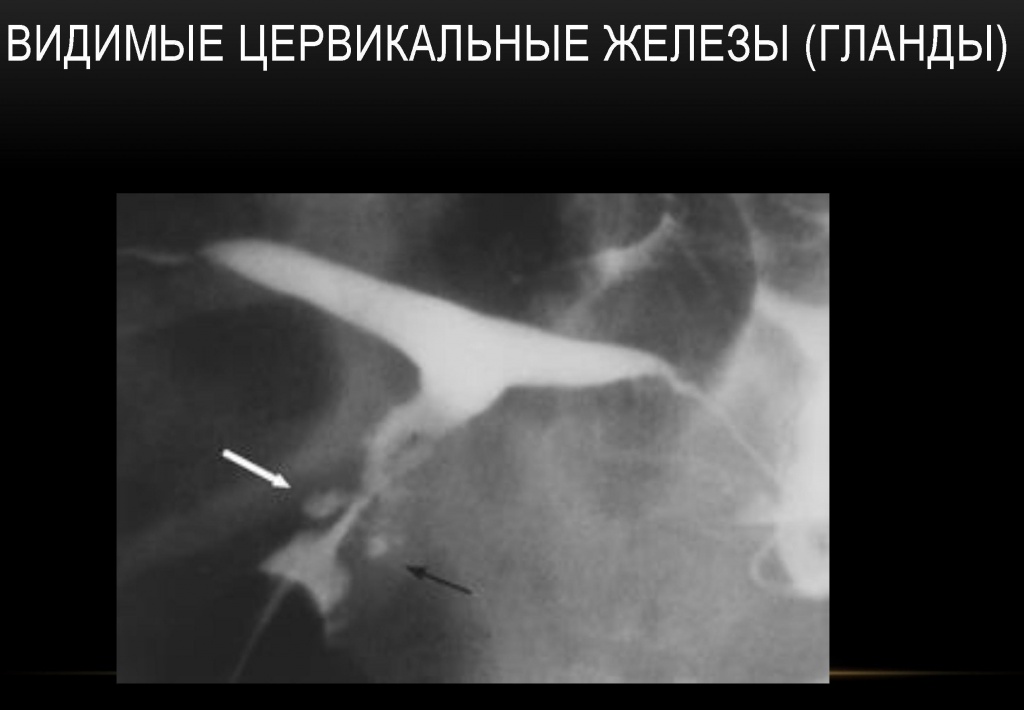 Цервикальные железы Цервикальные железы