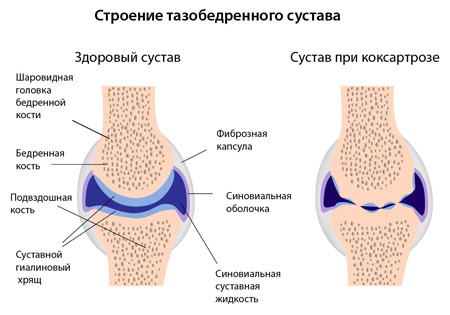 mehanizm-razvitiya-koksartroza.jpg